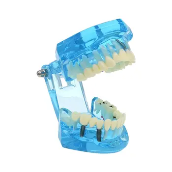 Skaidrus Typodont Suaugusiųjų Dantų Modelio Dantų Implantų Atkurti Ligos Patologija Su Nuimamais Dantų Mokymo Studijų
